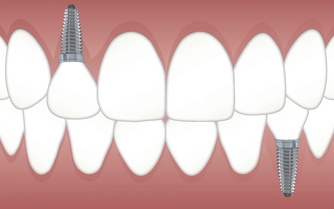 New Technology Makes Dental Implants More Affordable in 2019